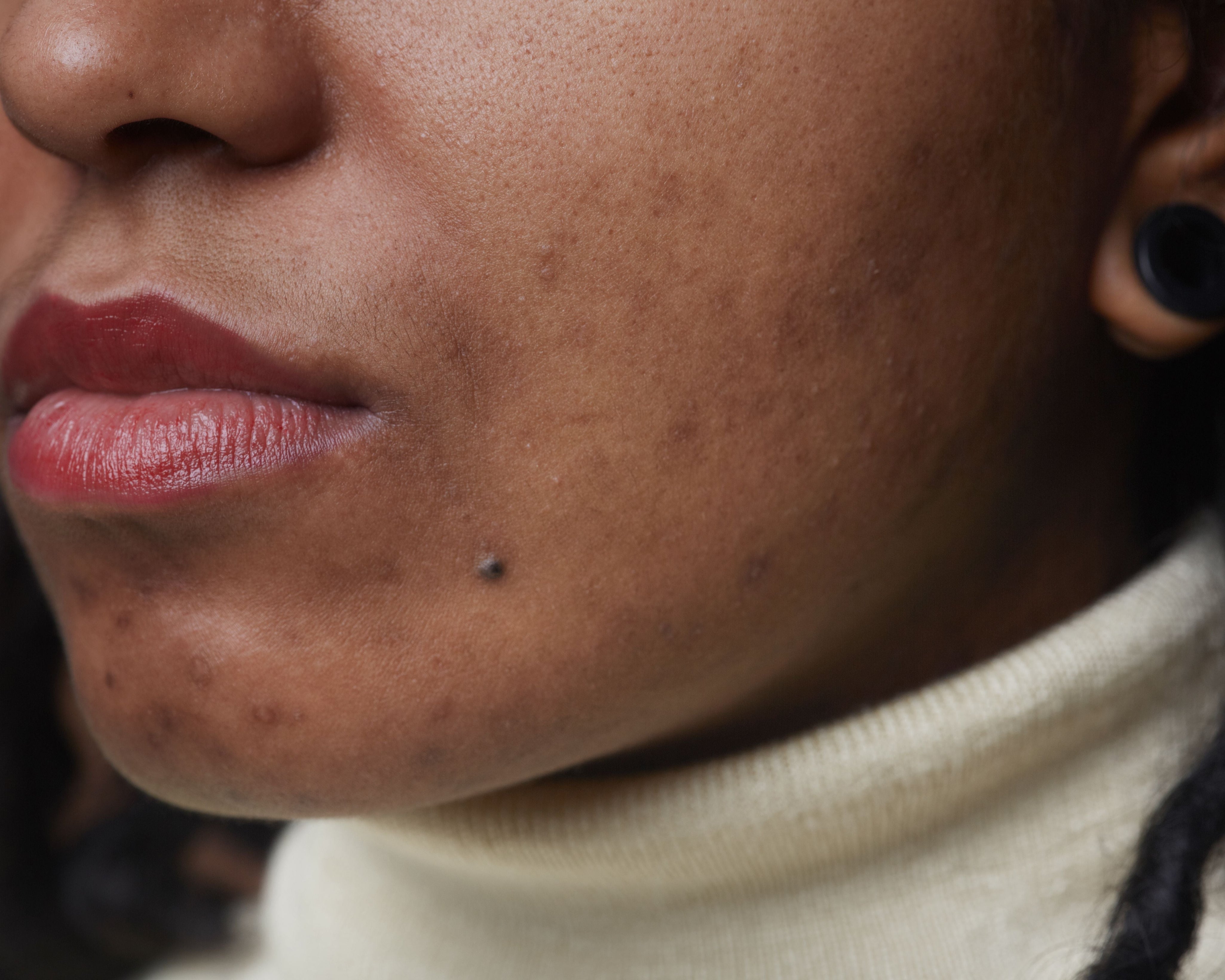 Why Your Acne Isn’t Going Away (and Why It’s Not Just a Skincare Issue)