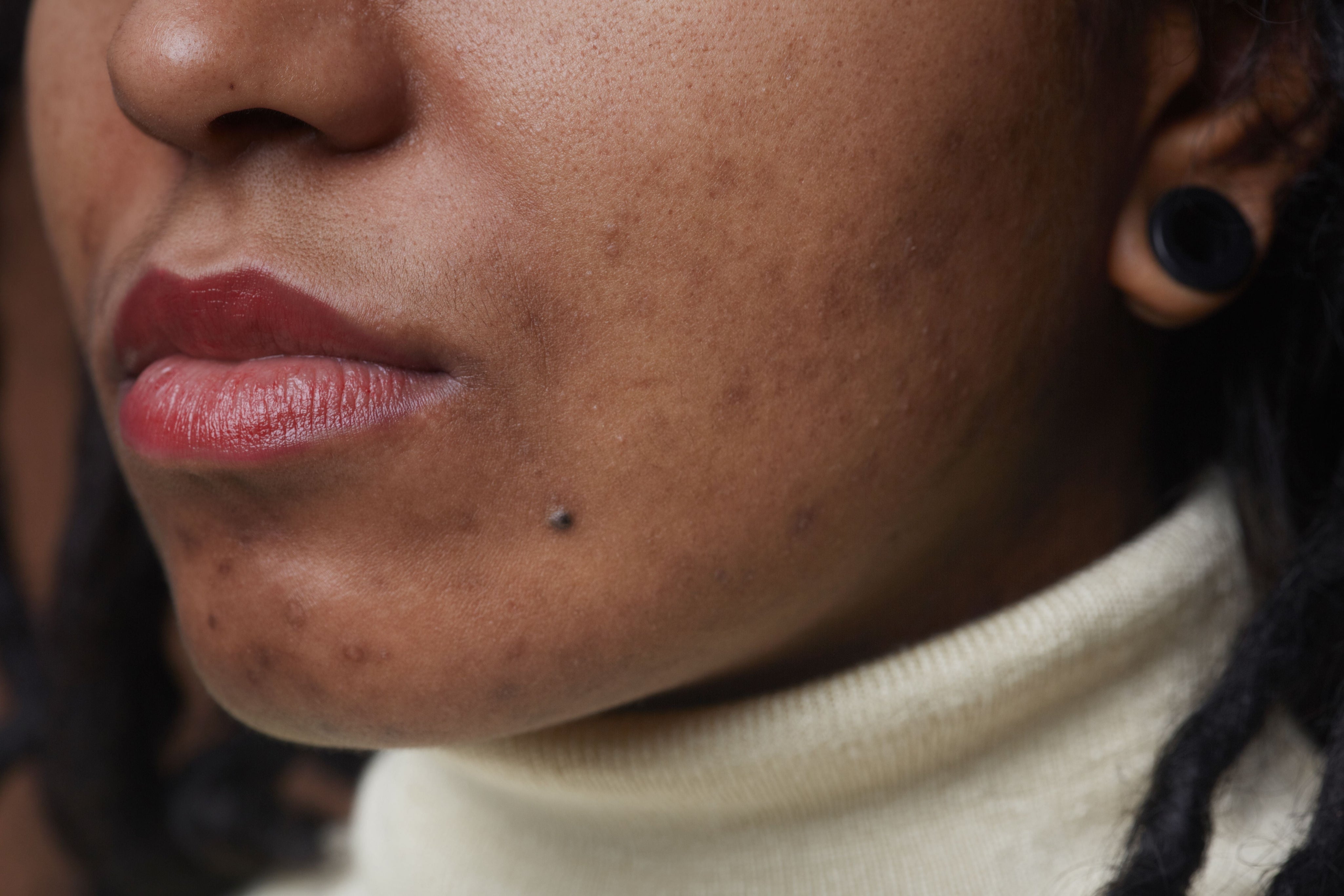 Why Your Acne Isn’t Going Away (and Why It’s Not Just a Skincare Issue)