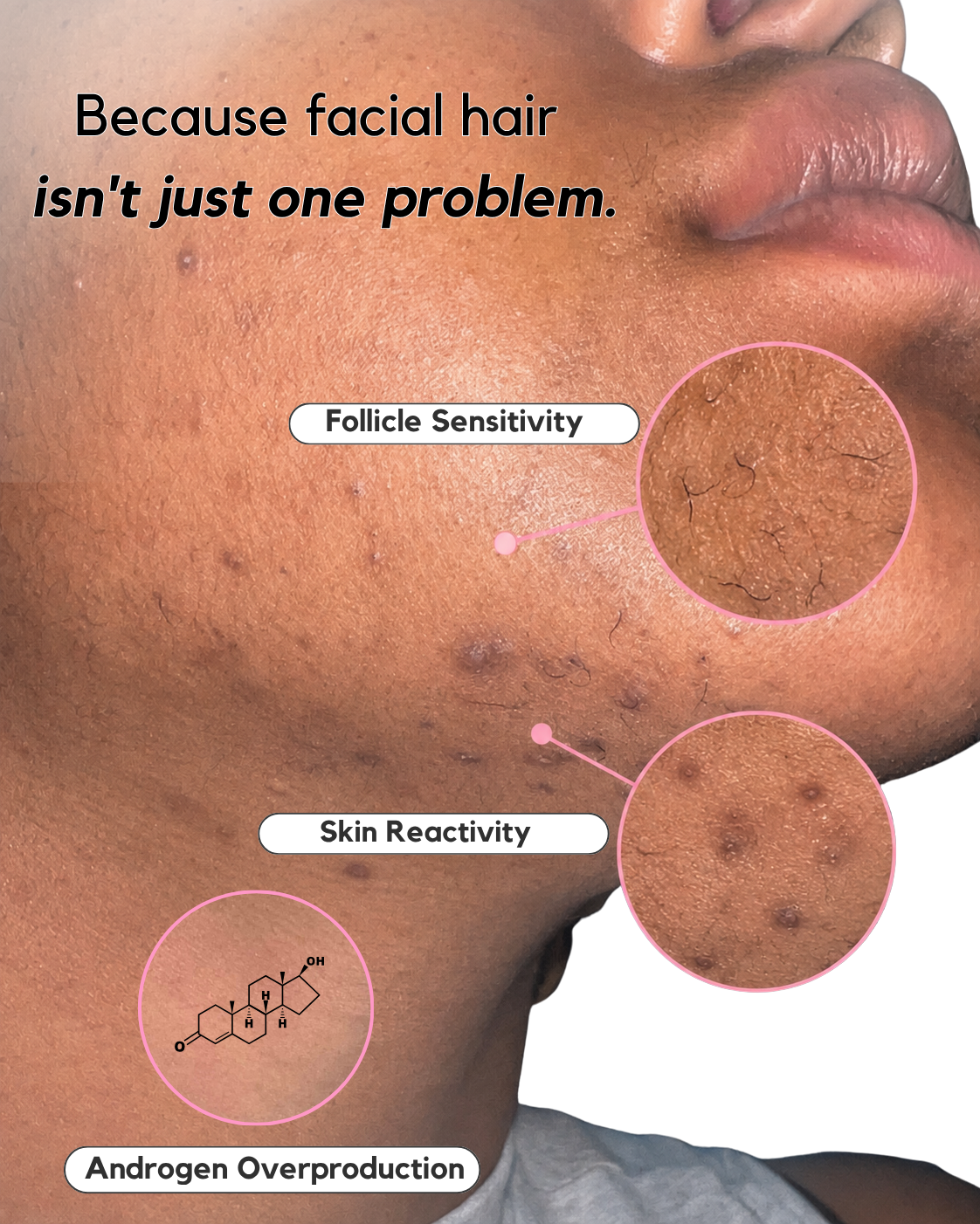 The Chin Kit – Complete Solution for Female Facial Hair & Hair Reduction